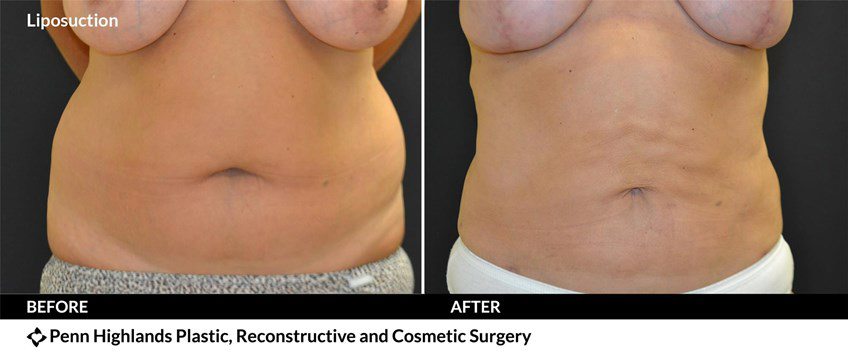 Liposuction - Before After Gallery